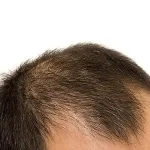 ریزش مو - طاسی با الگوی مردانه (آلوپسی آندروژنیک)