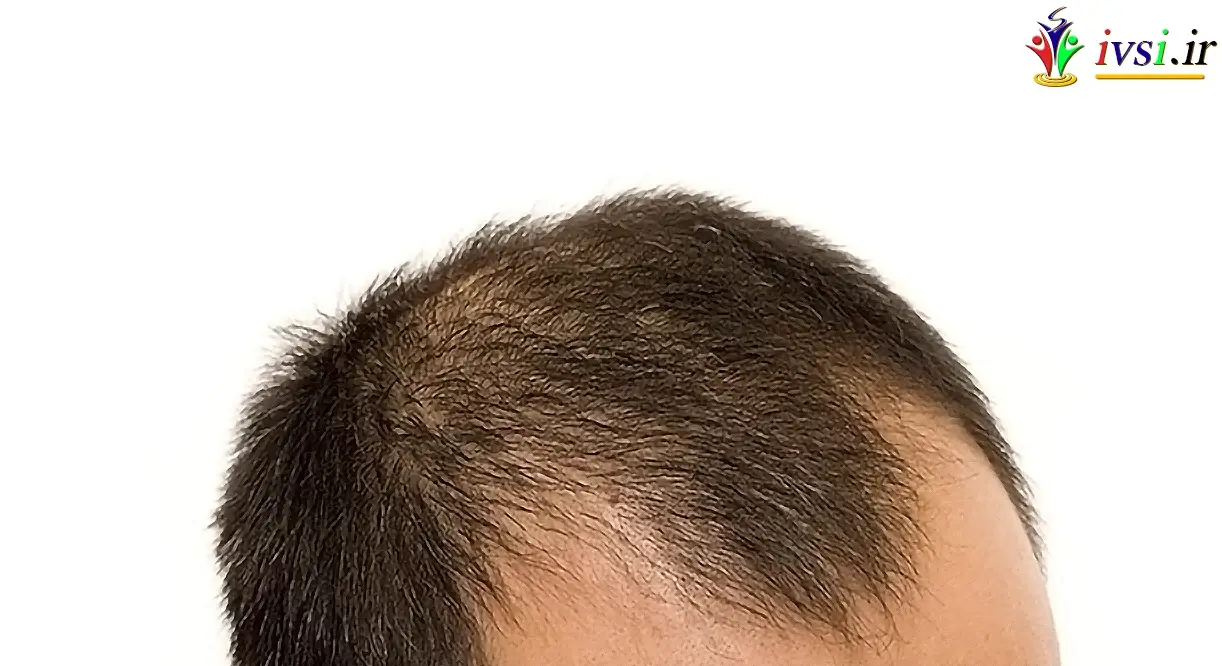 ریزش مو - طاسی با الگوی مردانه (آلوپسی آندروژنیک)